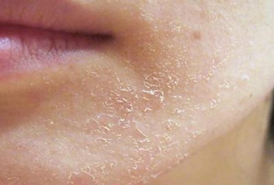 Phương pháp đơn giản để da không bị khô và bong tróc trong mùa lạnh