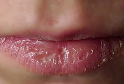 Cách đơn giản để nói lời tạm biệt đôi môi khô nứt nẻ trong mùa lạnh